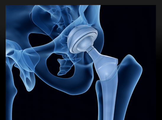 Hip Replacement