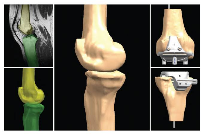 Knee Replacement