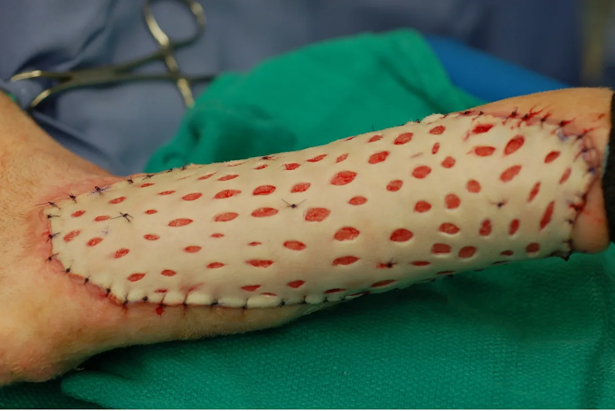 Skin Grafting